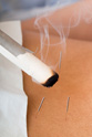 moxibustion